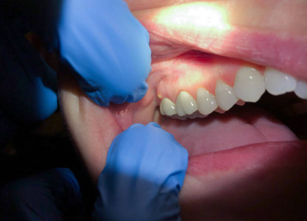Best Emergency Treatment for Dental Infections or Abscesses in Madera Acres, CA